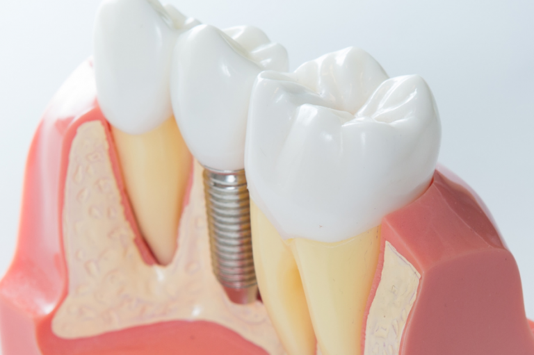 Can a dental implant fall out? FindGlob